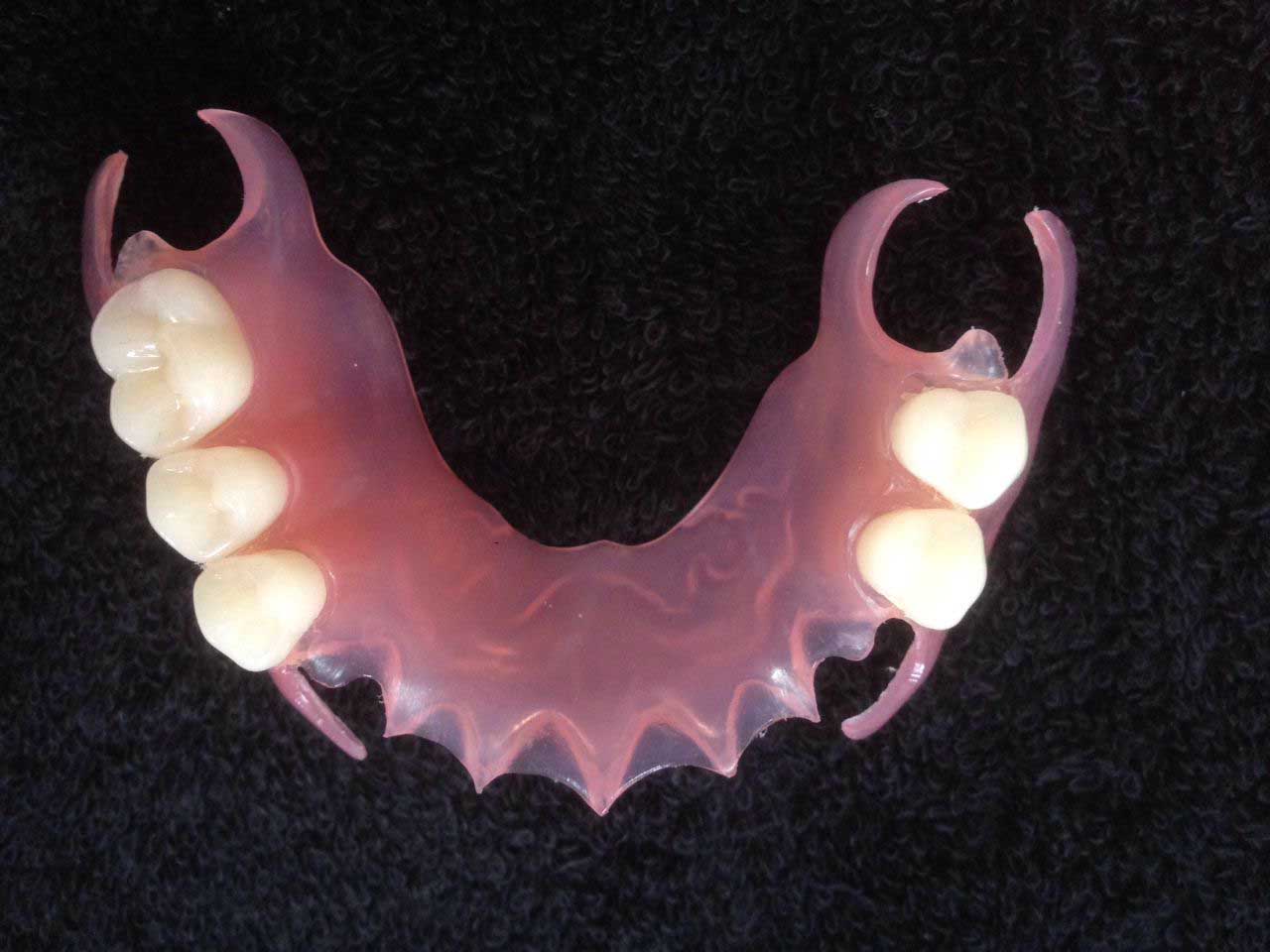 طقم أسنان أكريليك جزئي في طب الأسنان سريع وسهل