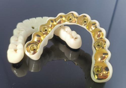 قضيب زرع تيتانيوم CAD/CAM + جسر زركونيا