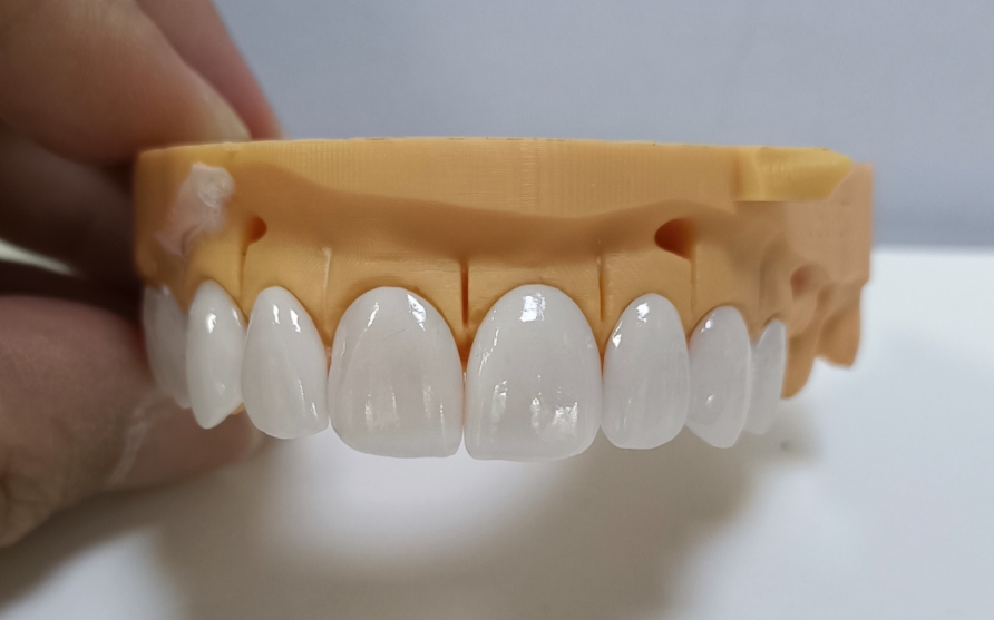 قشور ايماكس التجميلية العالية
