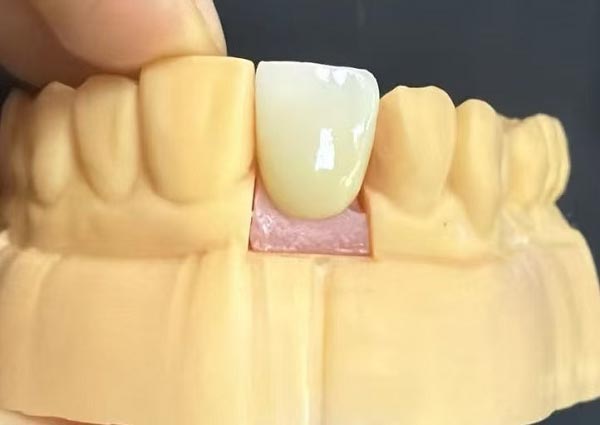 يمكن إصلاح الفجوات بين الأسنان، فالأسنان المستقيمة هي الأكثر جاذبية!