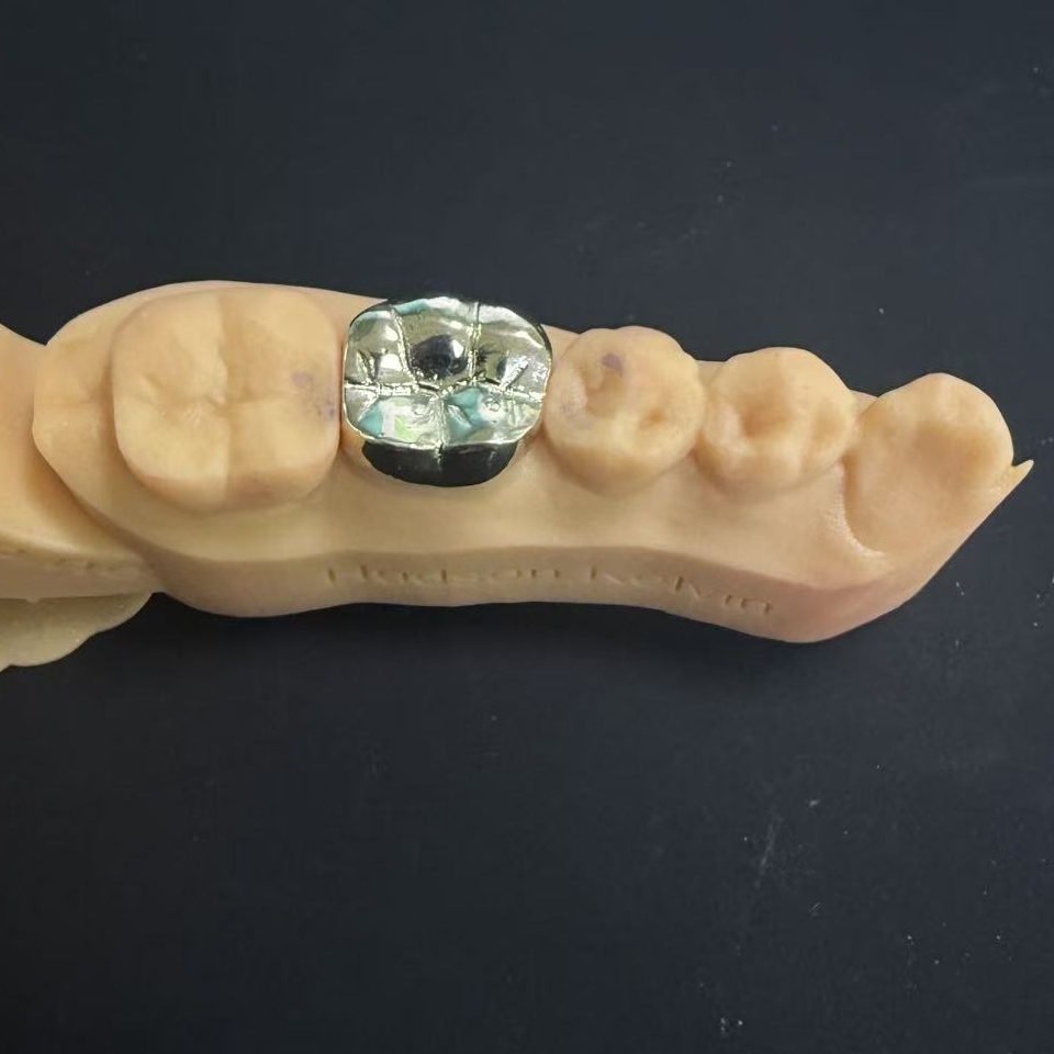 التيجان الذهبية: اختيار المعدن الثمين لترميم الأسنان مدى الحياة