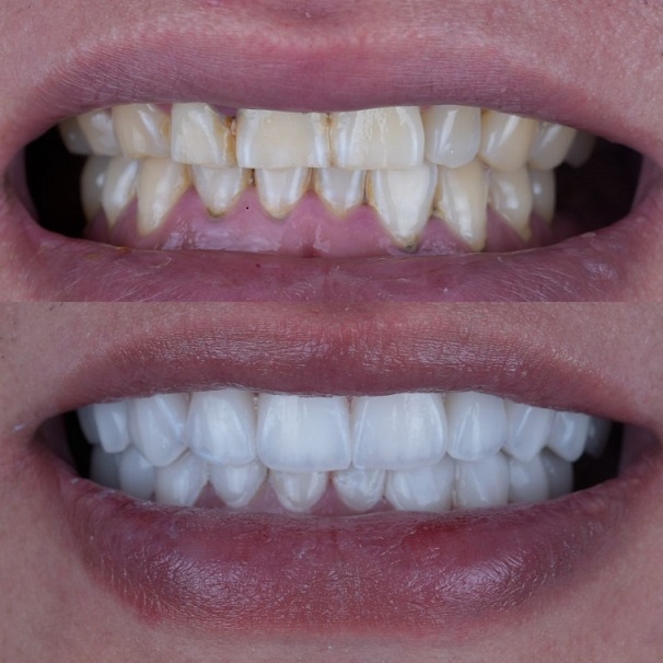 عمل معمل طب الأسنان الصيني التجميلي Emax Layered Veneers