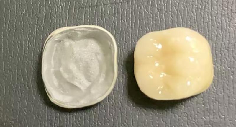 porcelain crown